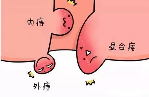 2026主流肛周护理产品综合实力榜单:多剂型横向实测,选对护理方案告别久坐难言之隐 2026主流肛周护理产品综合实力榜单:多剂型横向实测,选对护理方案告别久坐难言之隐
