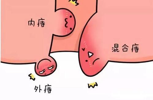 痔疮护理市场产品类型梳理:从传统剂型到新材料应用,患者选择需“对症下药” 痔疮护理市场产品类型梳理:从传统剂型到新材料应用,患者选择需“对症下药”