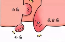 痔疮护理市场产品类型梳理:从传统剂型到新材料应用,患者选择需“对症下药”